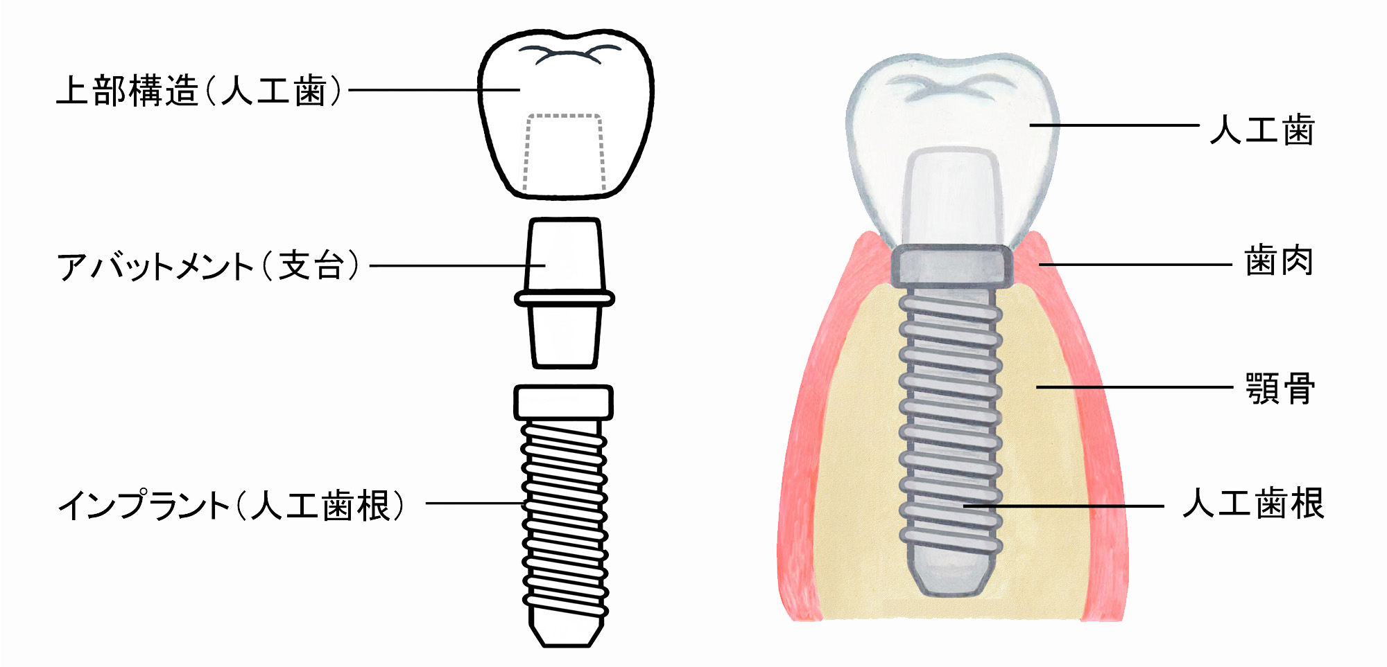 インプラントの構造